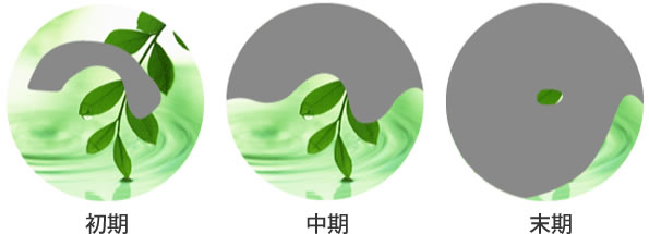 緑内障の症状