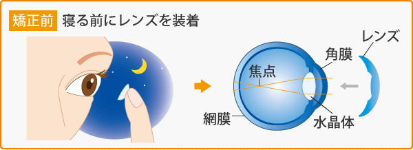 寝る前にレンズを装着