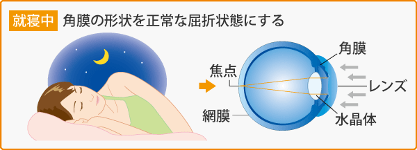 角膜の形状を正常な屈折状態にする