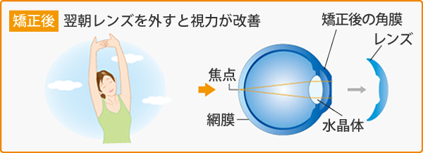 翌朝レンズを外すと視力が改善