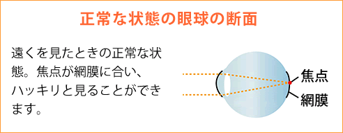 正常な状態の眼球の断面