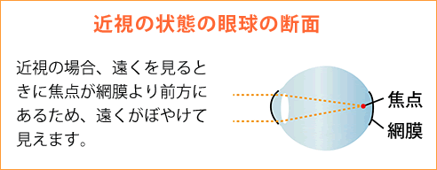 近視の状態の眼球の断面